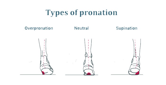types of foot pronation